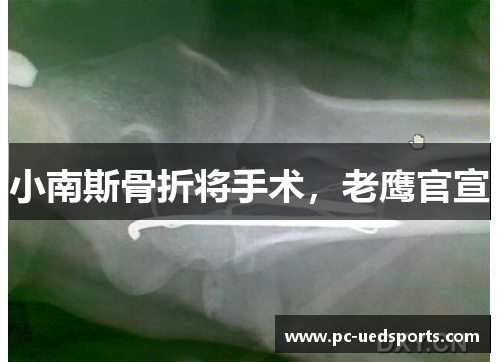 小南斯骨折将手术,老鹰官宣 小南斯骨折将手术,老鹰官宣